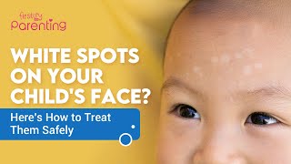 White Patches Or Spots On Childs Face  Causes and Treatments [upl. by Bara]