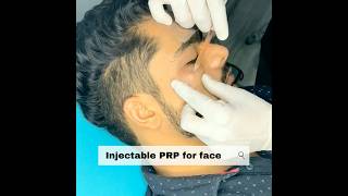 SAY NO TO ACNE amp SCARS prp face acne hermosaclinique  9351127811 [upl. by Tut]