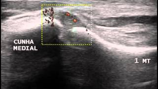 Ultrassom do Pé  Lesão do Ligamento entre o 1o Metatarso e o Cuneiforme Medial  Face inferior [upl. by Eimoan]