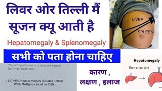 Liver ओर Spleen तिल्ली में सूजन क्यों आती है  Hepatomegaly amp Splenomegaly Causes  symptoms [upl. by Mikal687]