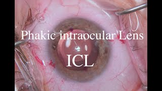 Phakic intraocular Lens ICL [upl. by Rhiana]