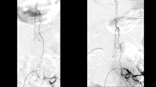 Endovascular treatment of a spinal dural arteriovenous malformation DAVF [upl. by Dnesnwot]