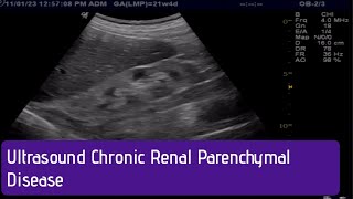 Ultrasound  How to Diagnose Chronic Renal Parenchymal Disease [upl. by Shea669]