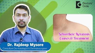 Black Warts on Face amp BackRemoval of SEBORRHEIC KERATOSIS skin DrRajdeep MysoreDoctors Circle [upl. by Laurena]