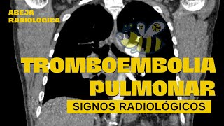 🔵🟡Signos radiológicos en tromboembolia pulmonar🔵🟡 [upl. by Roley]