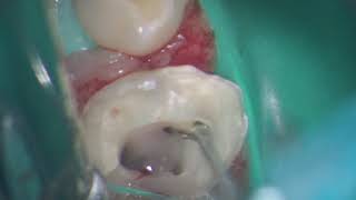 5 canals in upper maxillary 1st primary molar [upl. by Matazzoni]