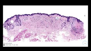 Desmoplastic Trichoepithelioma explained by a dermatopathologist Stain Summary in description [upl. by Kemppe959]