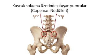 Kuyruk sokumu üzerinde oluşan yumrular Copeman nodülleri [upl. by Apilef]