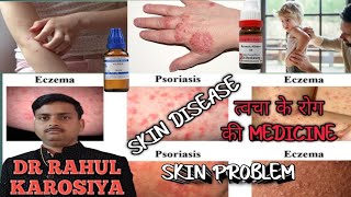 Skin disease skin problem Best Homeopathic Medicines eczema [upl. by Nilcaj]