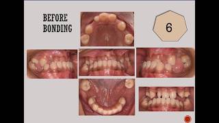 Different Types of Malocclusion  Treatment at BPKIHS Dharan Department of Orthodontics [upl. by Tirrell]