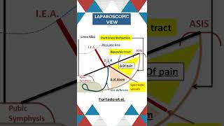 Triangle of pain in Inguinal hernia surgicaleducation biology conceptualsurgery [upl. by Anthiathia]