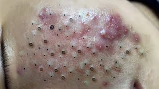 Big Cystic Acne Blackheads Extraction Blackheads amp Milia Whiteheads Removal Pimple Popping  9202 [upl. by Notlil]