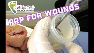 PRP for Wounds Platelet Rich Plasma Foot Wound and Ulcer [upl. by Bryn877]