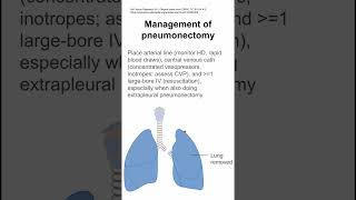 Management of pneumonectomy [upl. by Millburn246]