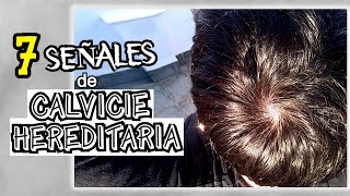 Cómo Saber Si Tienes Alopecia Genética AGA o Calvicie Común  Señales de Calvicie [upl. by Edwards341]