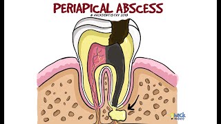 Periapical Abscess [upl. by Nomor]