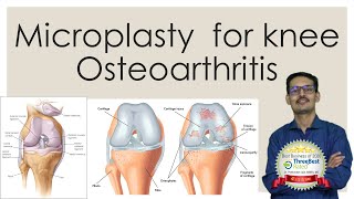 Microplasty  Unicondylar Knee Arthroplasty [upl. by Marty]