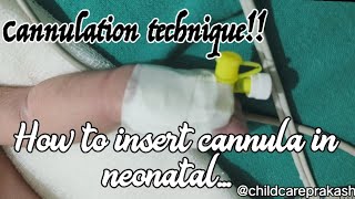 Cannulation technique in neonatalcannula injection crying [upl. by Devinne]