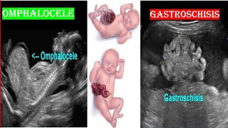 Omphalocele VS Gastroschisis on Ultrasound [upl. by Oraneg44]