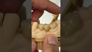 Posterior Zen Enamel Bridge EnvisiontecMain envisiontec teeth dental lsk121shorts [upl. by Gaillard]