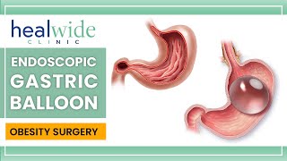 Gastric balloon  Endoscopic Gastric Balloon  nonsurgical weightloss procedure  in TURKEY [upl. by Cornall]