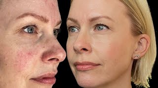 HOW I FIXED my rosacea ‼ [upl. by Greene]