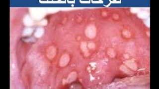 متلازمة بهجت للدكتور فهيد السبيعي BEHCETS DISEASE DRFOHEID ALSOBEI [upl. by Iphigeniah487]