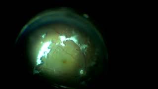 Vitrectomy  PPV surgery in VFT associated Macular hole  Rajeev Gupta Sangam Netralaya Mohali [upl. by Hearn]