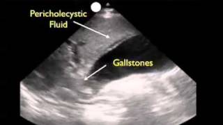 How To Gallbladder Ultrasound Part 3  Acute Cholecystitis Case Study Video [upl. by Ilse]