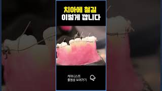 치아에 철길 이렇게 깝니다 [upl. by Oppen]