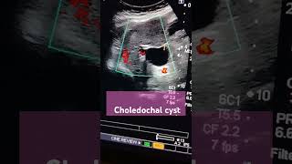 choledochal cystliverporta hepatisabdominal ultrasound [upl. by Ahsonek606]