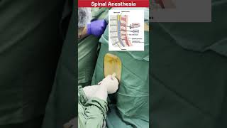 How spinal Anesthesia procedure is performed in Surgery doctor mbbs neet medical anesthesia [upl. by Winstonn428]