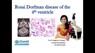 RosaiDorfman disease of the fourth ventricle [upl. by Valida]