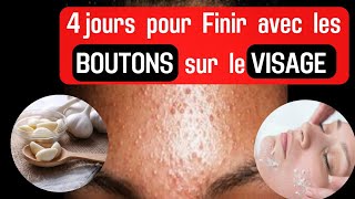 COMMENT ELIMINER LES BOUTONS SUR LE VISAGE [upl. by Caz432]