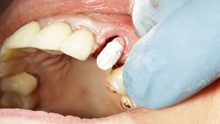 Immediate Provisional Using Peek Temp Abutment [upl. by Neelyak]