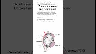 Placenta accreta and risk factors [upl. by Leahciam]