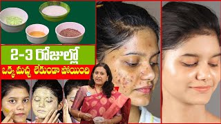 Remove Pimples and Acne Scars by Homemade Face Pack  Dark Spots  Dr Jyothsna  iD Health 360 [upl. by Plumbo]