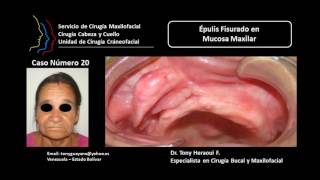 Tony Heraoui Cirugía Maxilofacial Caso 20 [upl. by Nwadal]