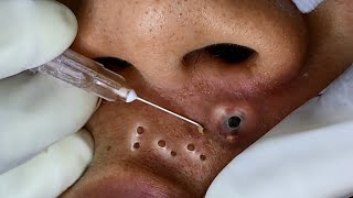 Big Cystic Acne Blackheads Extraction Blackheads amp Milia Whiteheads Removal Pimple Popping [upl. by Stanislas126]