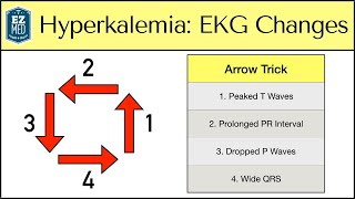 Intro to EKG Interpretation  Chamber Enlargement [upl. by Notlaw]