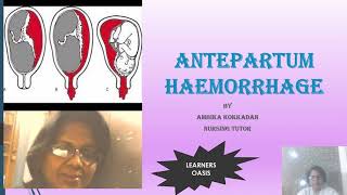 ANTEPARTUM HAEMORRHAGE APH [upl. by Lashonde]