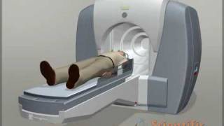 Neurology animation  Gamma Knife Surgery [upl. by Jurgen]