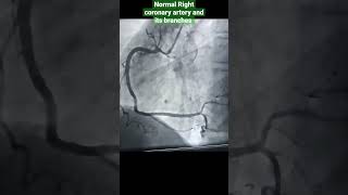 Normal Right coronary artery and its branches l SA node  AV node artery l youtubeshorts [upl. by Lezlie]