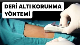 NEXPLANON DERİALTI DOGUM KONTROL İMPLANT doğumkontrolhapı korunmayöntemleri derialtıimplant [upl. by Baecher]