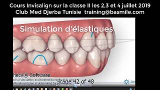 Invisalign et classe II  Les 4 solutions Invisalign [upl. by Esekram]