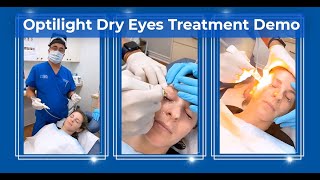 IPL Treatment for Dry Eyes amp Inflammation Rosacea Styes MGD  Lumenis Optilight [upl. by Lukash]