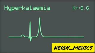 Electrocardiography  ECG changes in HYPERKALEMIA [upl. by Alpheus]