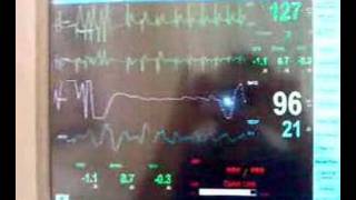 Chemical cardioversion of SVT [upl. by Bocoj883]