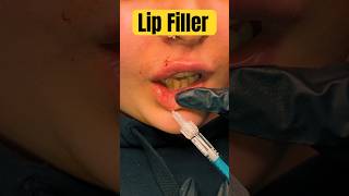 Lip Filler Tutorial channel [upl. by Siddra]