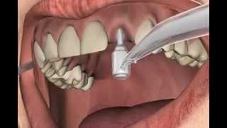 Stanzen statt schneiden bei Zahnimplantaten [upl. by Saberio890]